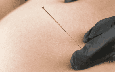 What is Dry Needling?