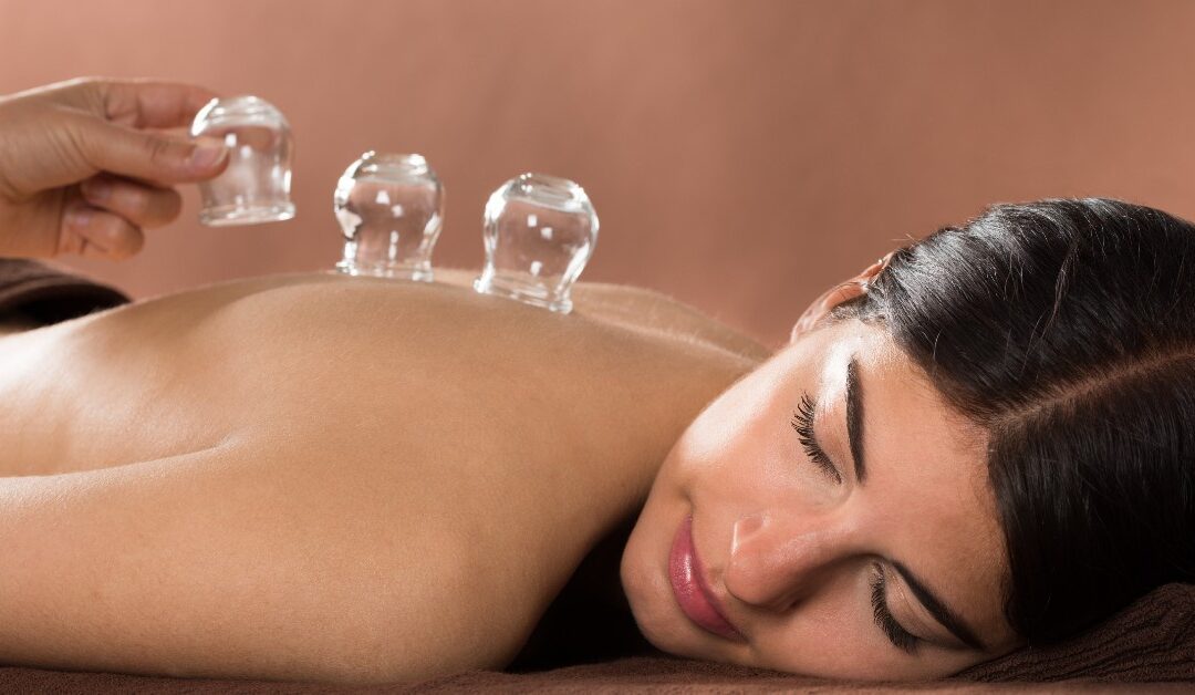 What Is Cupping Therapy? Does It Work?