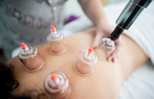 cupping 3 Cupping therapy being performed